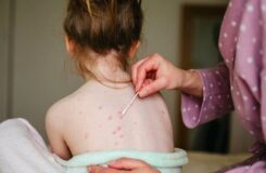 В Казахстане зарегистрированы случаи ветряной оспы, санврачи призывают к осторожности